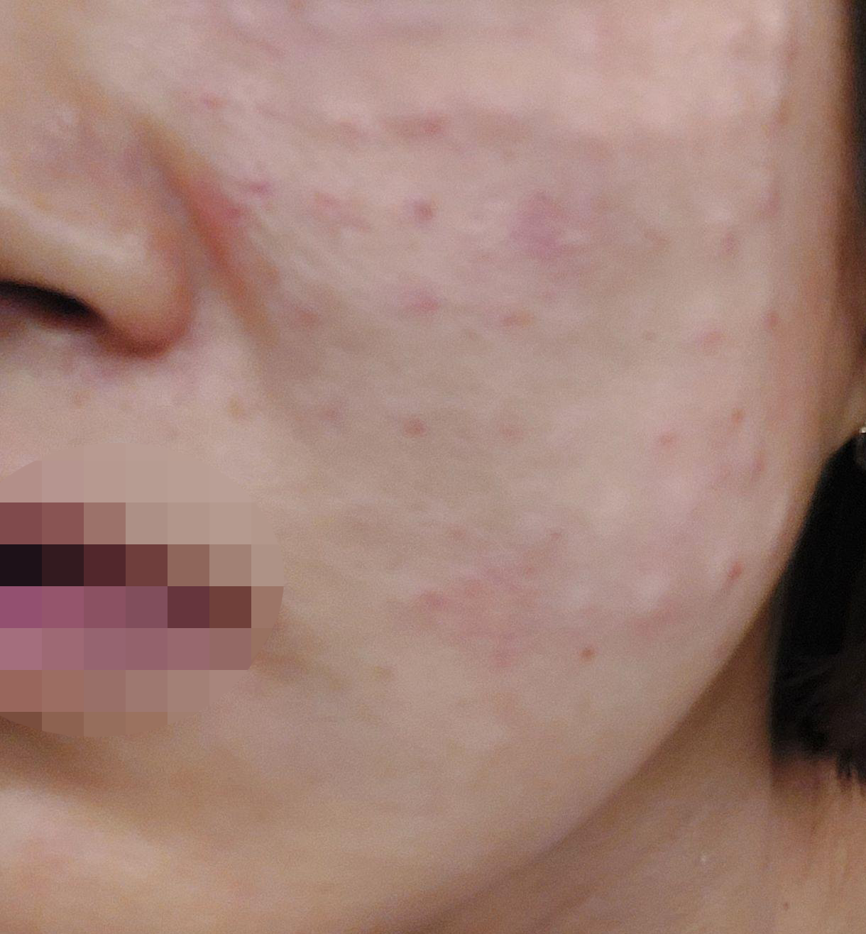 엠보 촘촘하게 잘 올라와서 앞으로 더 예뻐질 피부가 기대돼요ㅎㅎ