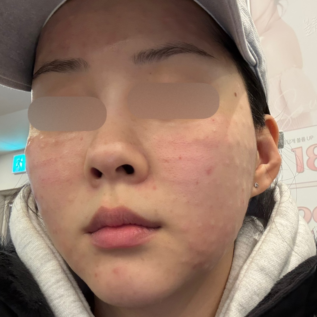 본식 한 달 전 수면 리쥬란 맞았는데 진작 받을 걸 그랬어요