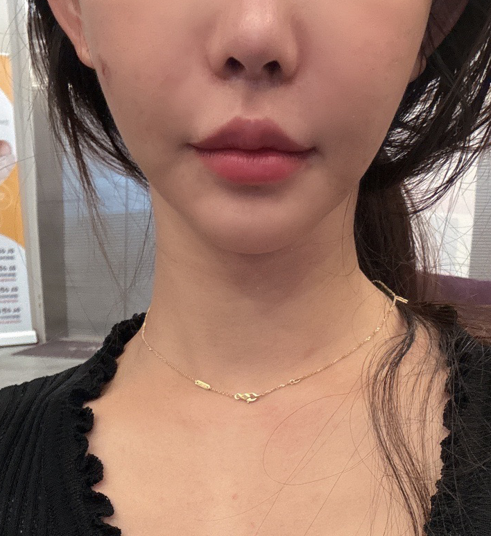 꾸준히 관리하는 편인데 슈링크 받길 잘한 것 같아요!! 만족스러워요~