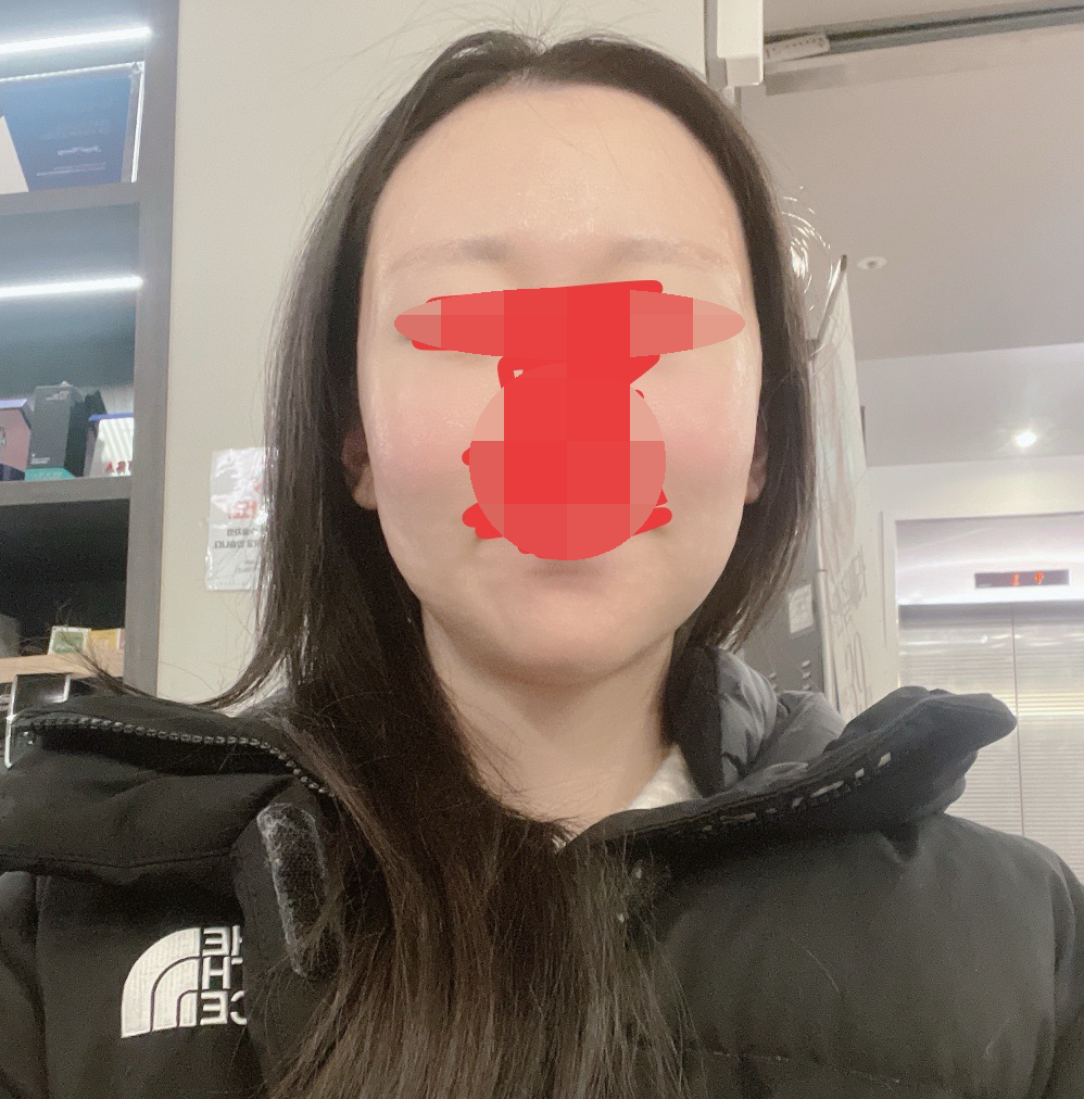 리쥬란 받았는데 바로 촉촉해져서 만족이에요ㅎㅎ!!