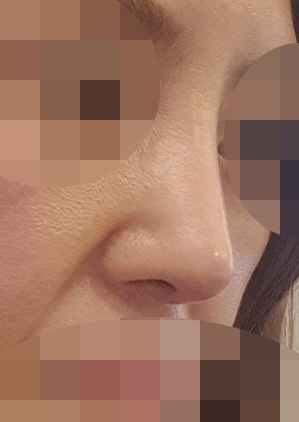 코라인 예뻐져 넘 만족하고있다
