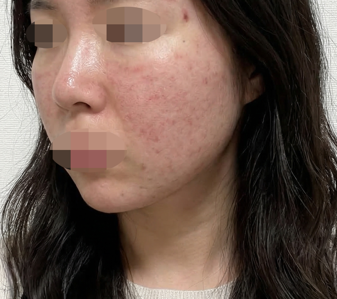 효과 좋아서 재방문했는데 상담부터 시술까지 꼼꼼한 것 같아요 ㅎㅎ