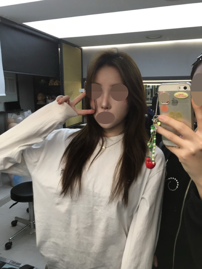 직후보다 콧대와 코끝의 라인이 훨씬 자연스러워졌고 얼굴의 전체적인 균형도 맞아 보이네여
