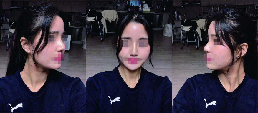 벌써 코수술 한달차네용