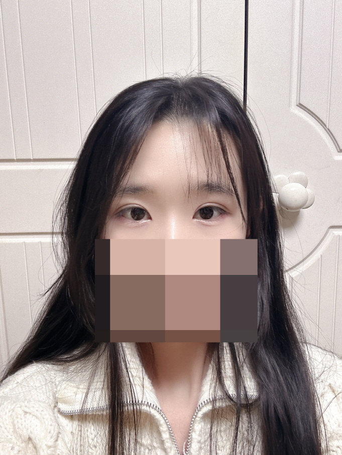 원하는 라인대로 만족스러운 쌍꺼풀이 생겼어요!!!