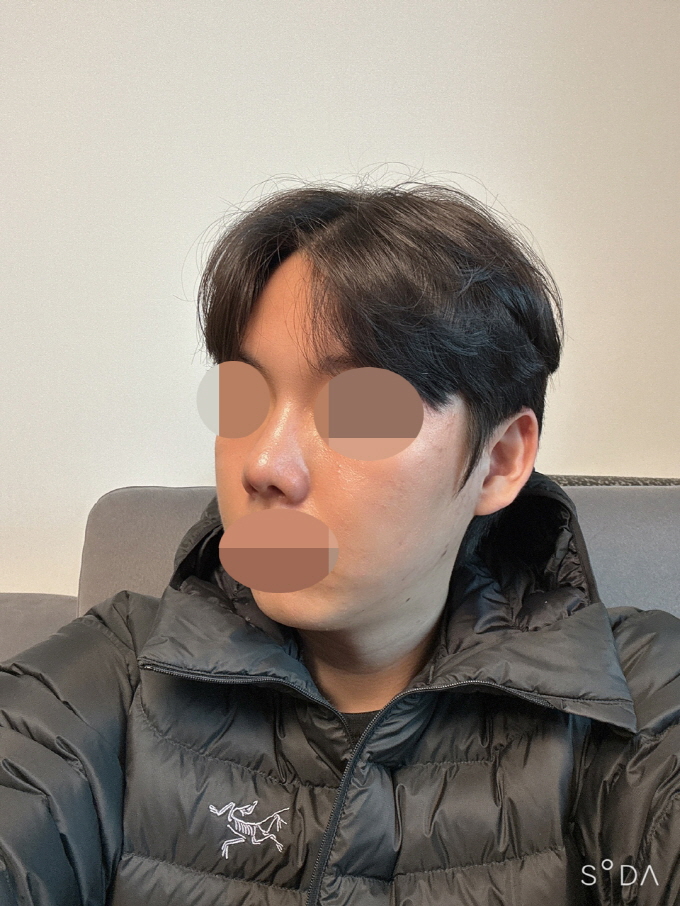 붓기 빠지니 제가 원하는 코가 되어 너무 좋아요