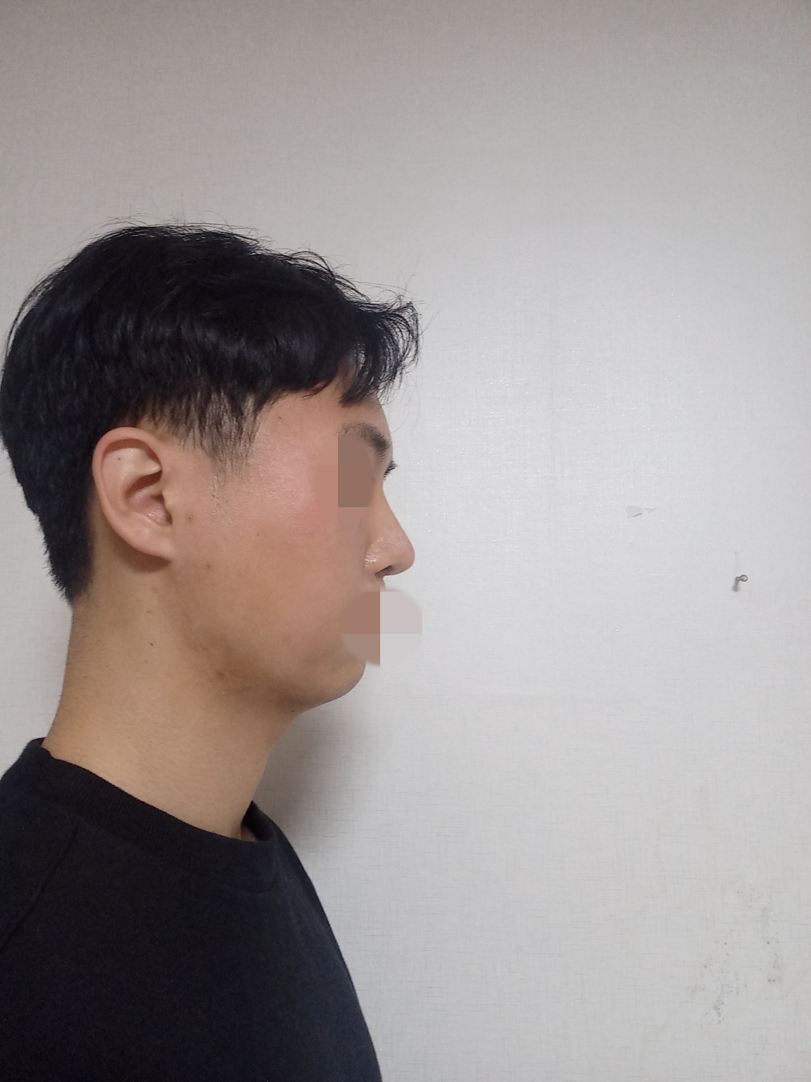 개선을 원했던 들창코나 코끝처짐이 개선되어서 만족스럽습니다.