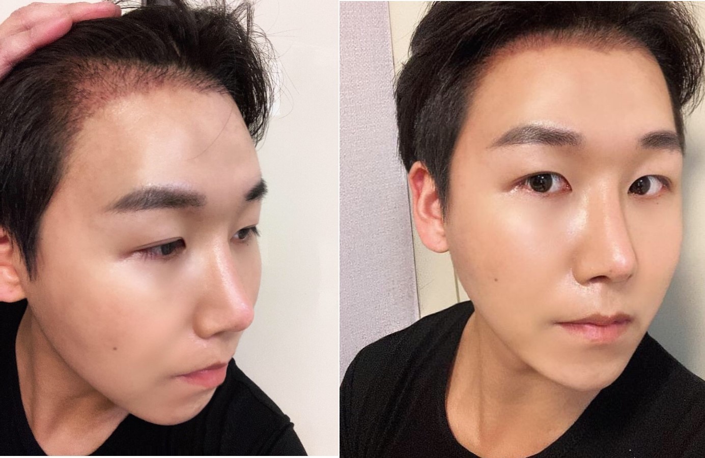 모발이식 2주차