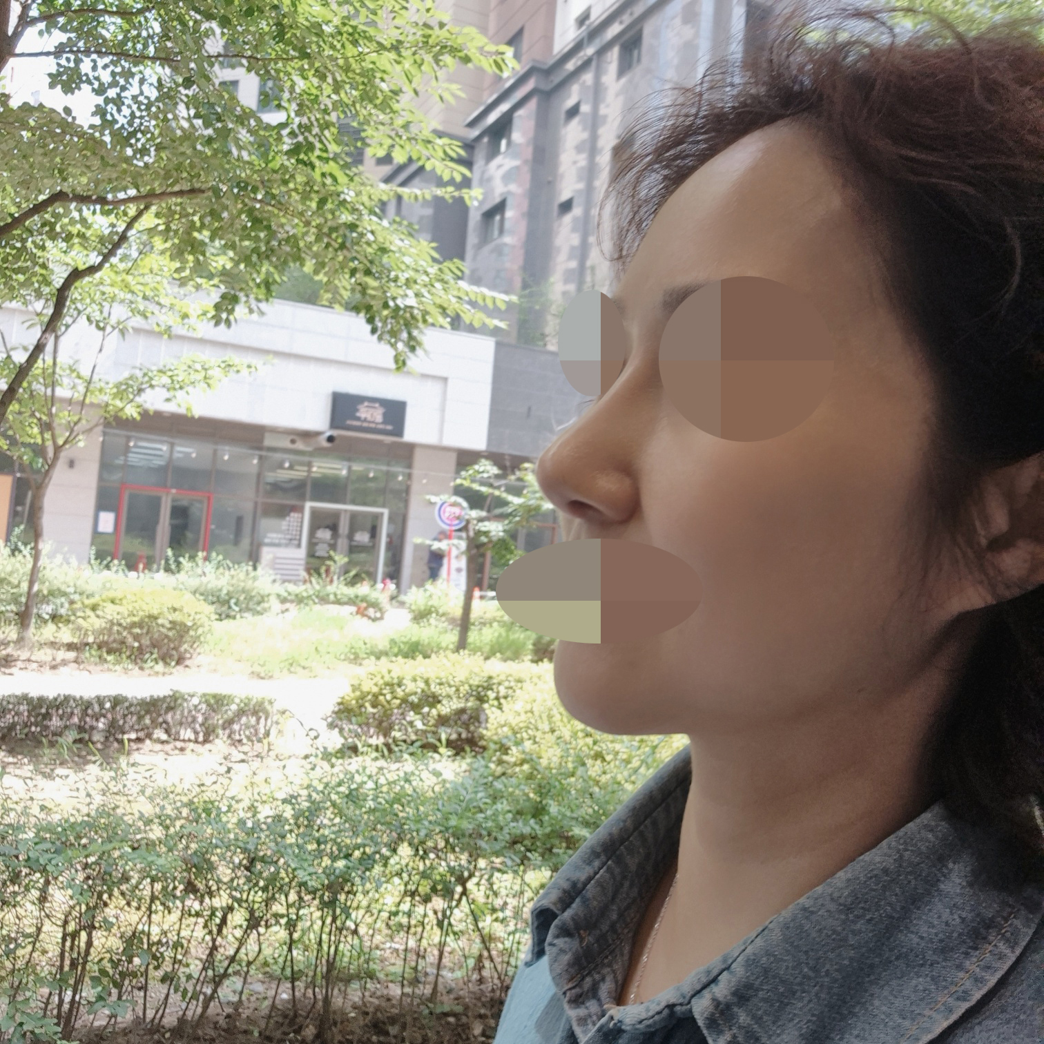 황정일 원장님 섬세한 손, 코성형 2주차 후기예요