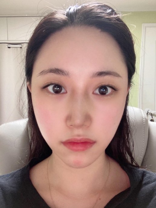 메부리코 콤플렉스 해결했습니다