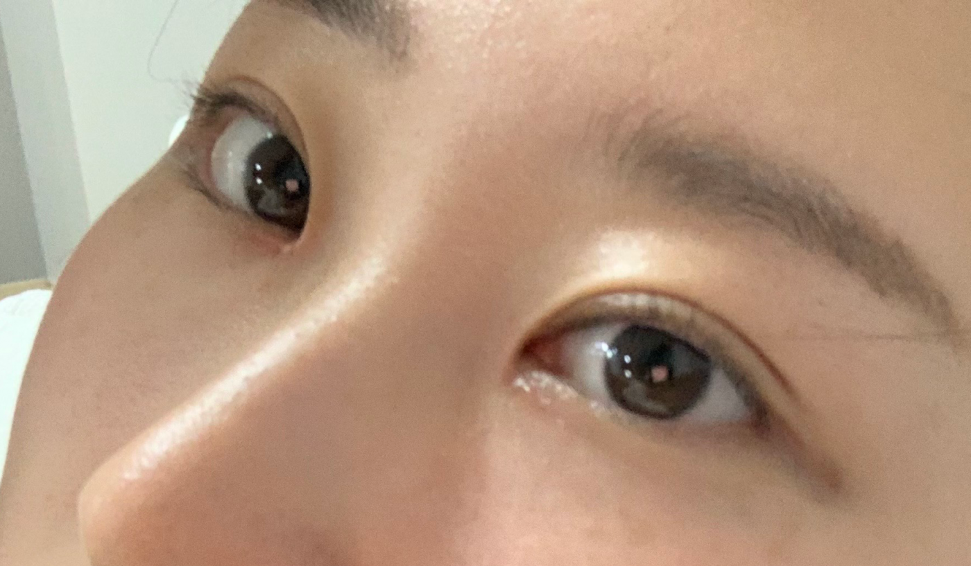 수술 후 두 달 되었는데 이제 진짜 자연스러워서 쌍수한거 말 꺼내지 않으면 몰라요 ^*^
