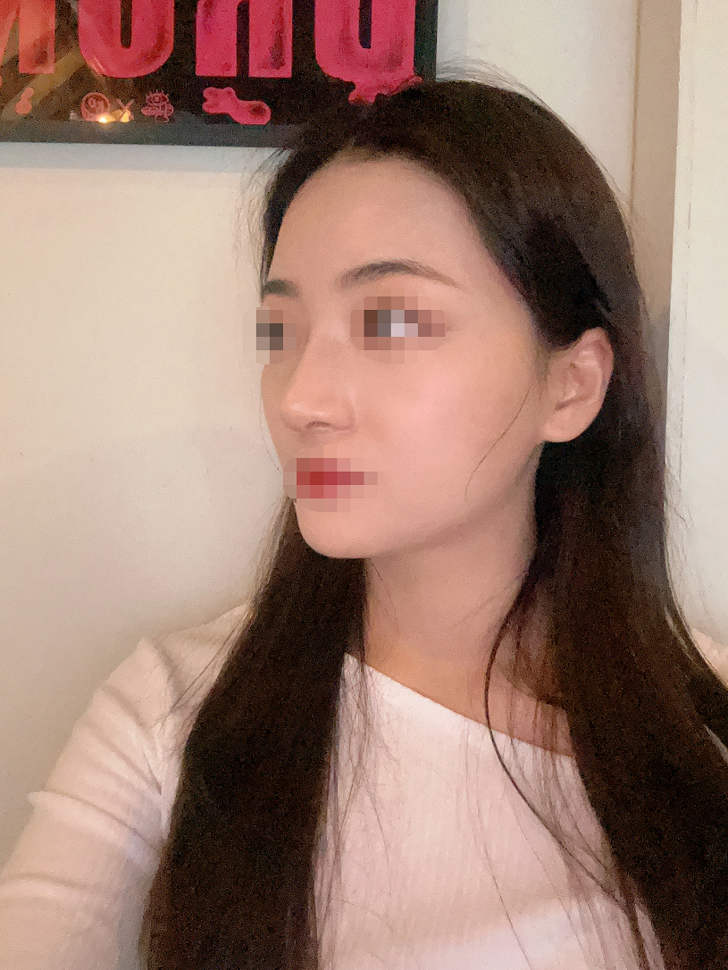 화살코 결론적으로 코가 정말 작아졌고 상당히 교정됐어요! 너무 만족해요