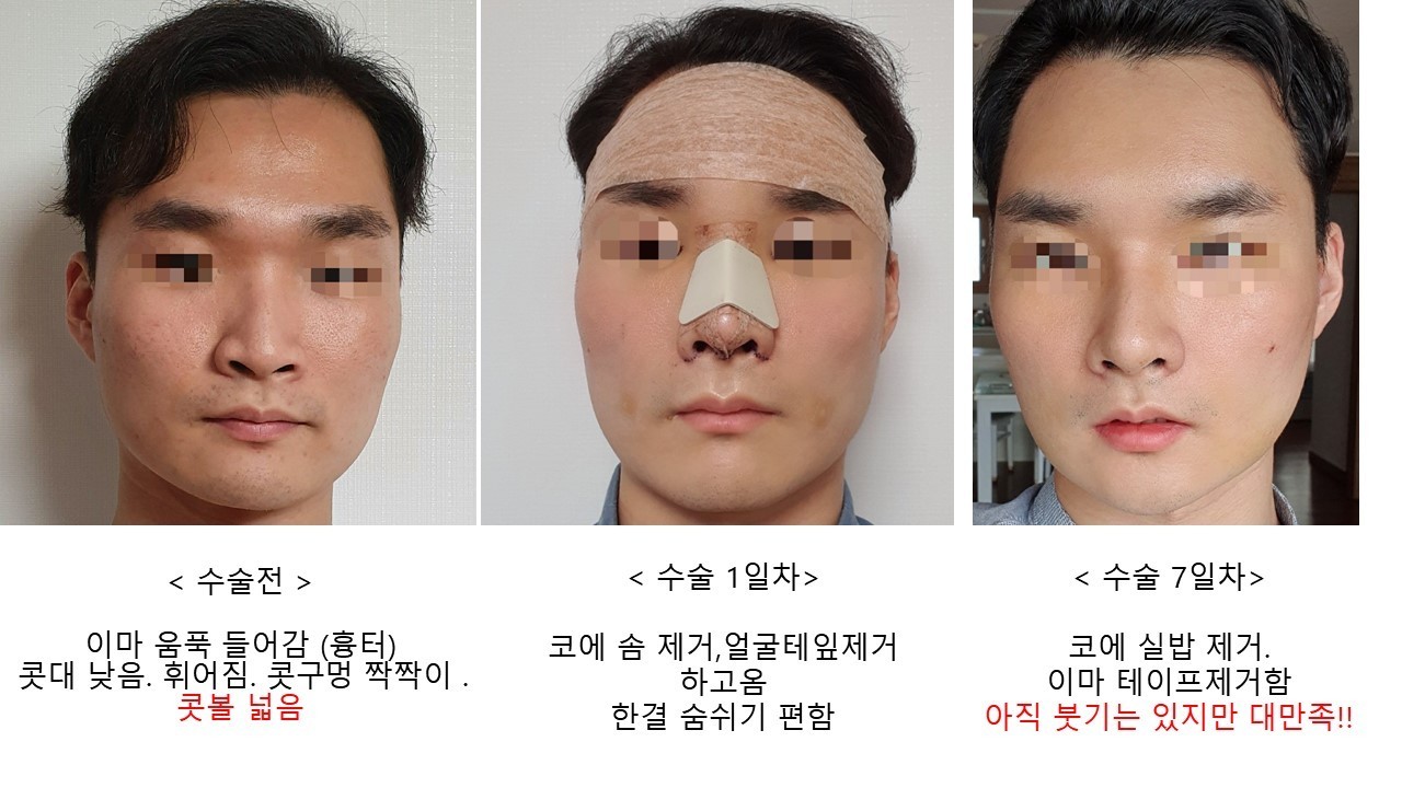 코(비중격+콧볼축소+매부리+휜코), 지방이식(전체) 7일차 100% 리얼후기! 황정일 원장님 감사드립니다!
