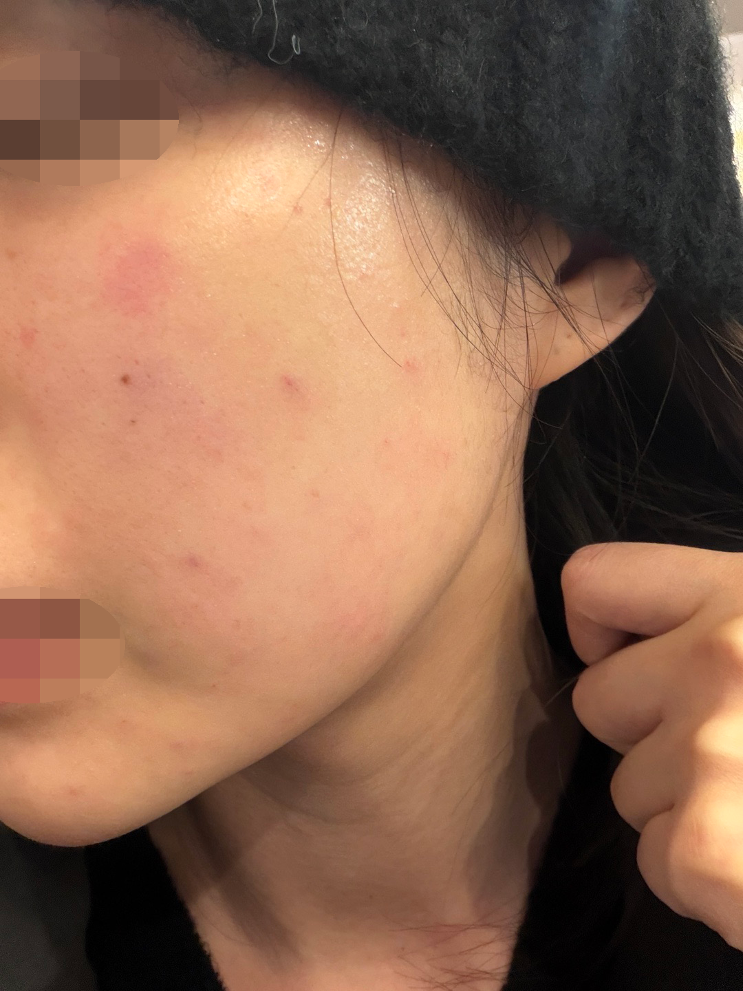 건조해서 쥬베룩 받았는데 친절한 곳 에서 받아서 넘 좋았어요~ 얼굴에 광 나는 게 좋네요 ㅎㅎ