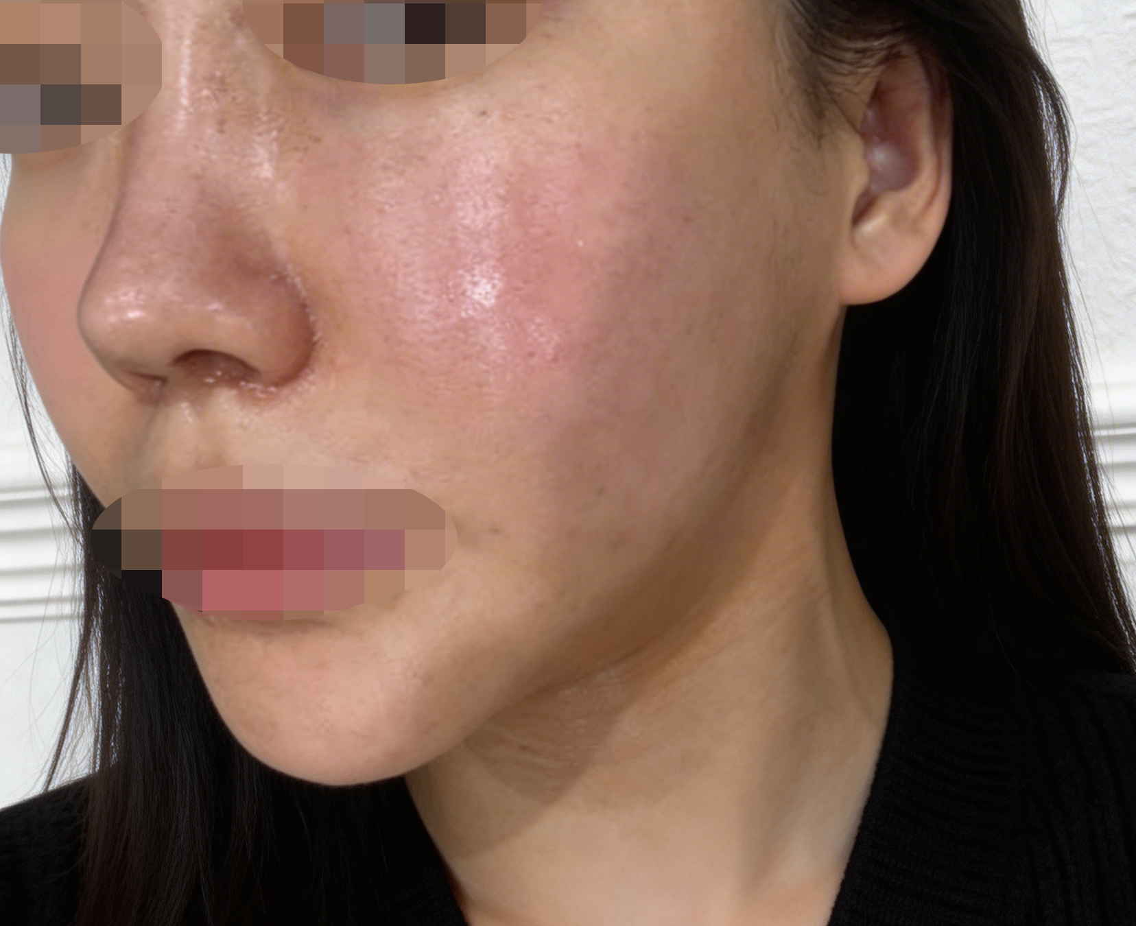 온다리프팅 좋다고 해서 왔는데 과한 권유 없이 편하게 받았어요 ㅎㅎ