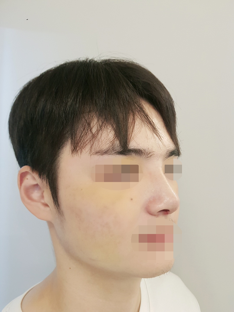 상담실장님의 정확한 피드백으로 궁금증도 해결 되었고 너무 만족스러워서 다른 병원 상담 예약 다 취소하고 수술했…