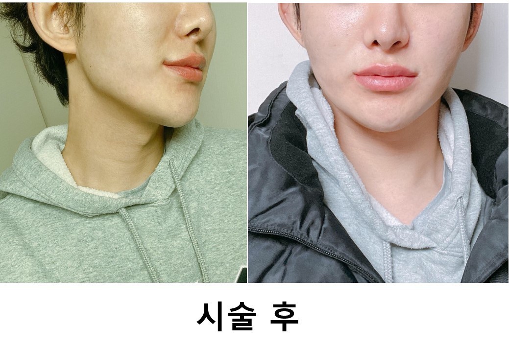 실리프팅 했습니당
