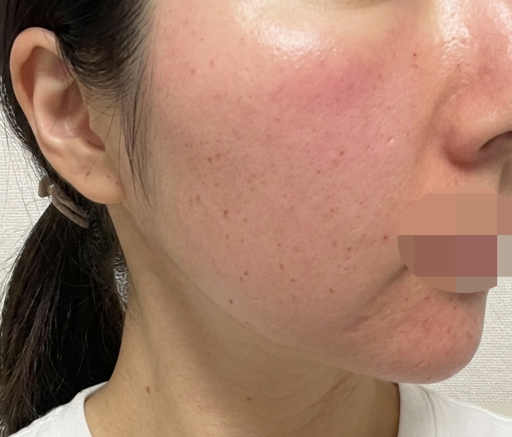 모공이랑 속건조 케어 위해 두 시술 한 번에! 만족스러운 후기예요!!