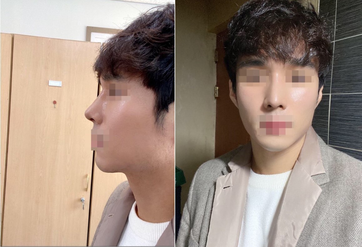 코수술 2주