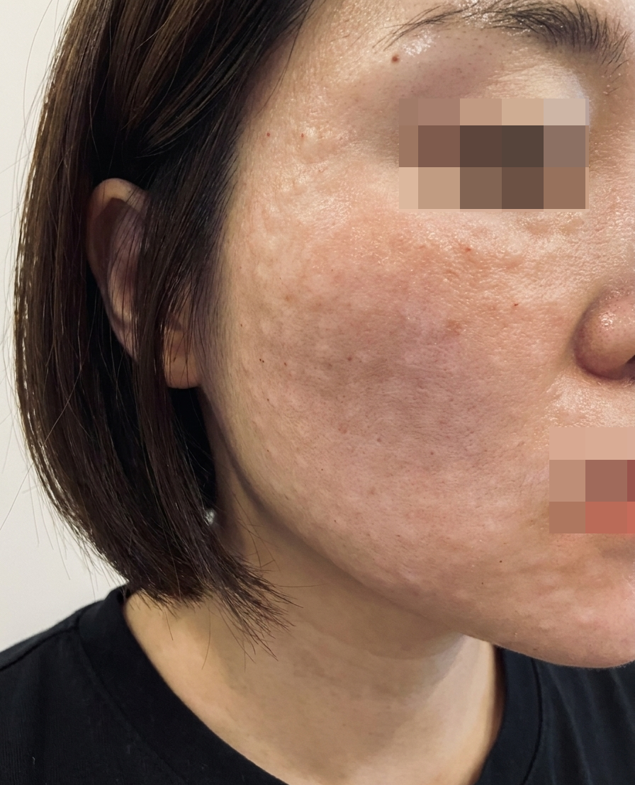 통증 없이 미친 광 피부! 주기적 리쥬란 강추드려요