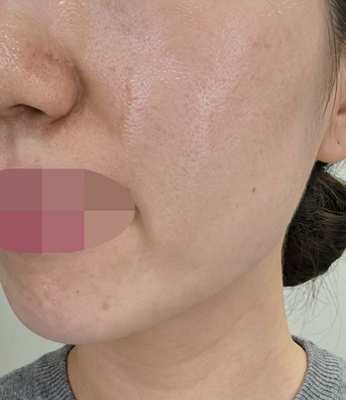 급격히 떨어진 피부 컨디션 고칠려고 쥬베룩 한번 받아봤어요~ㅎㅎ