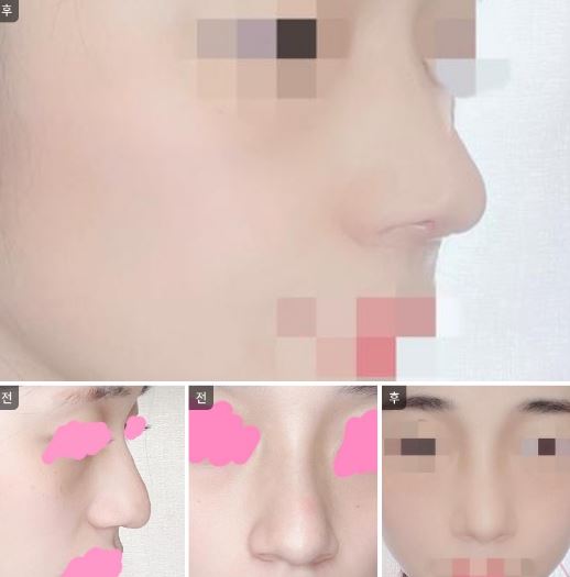붓기 많이 빠졌죵?