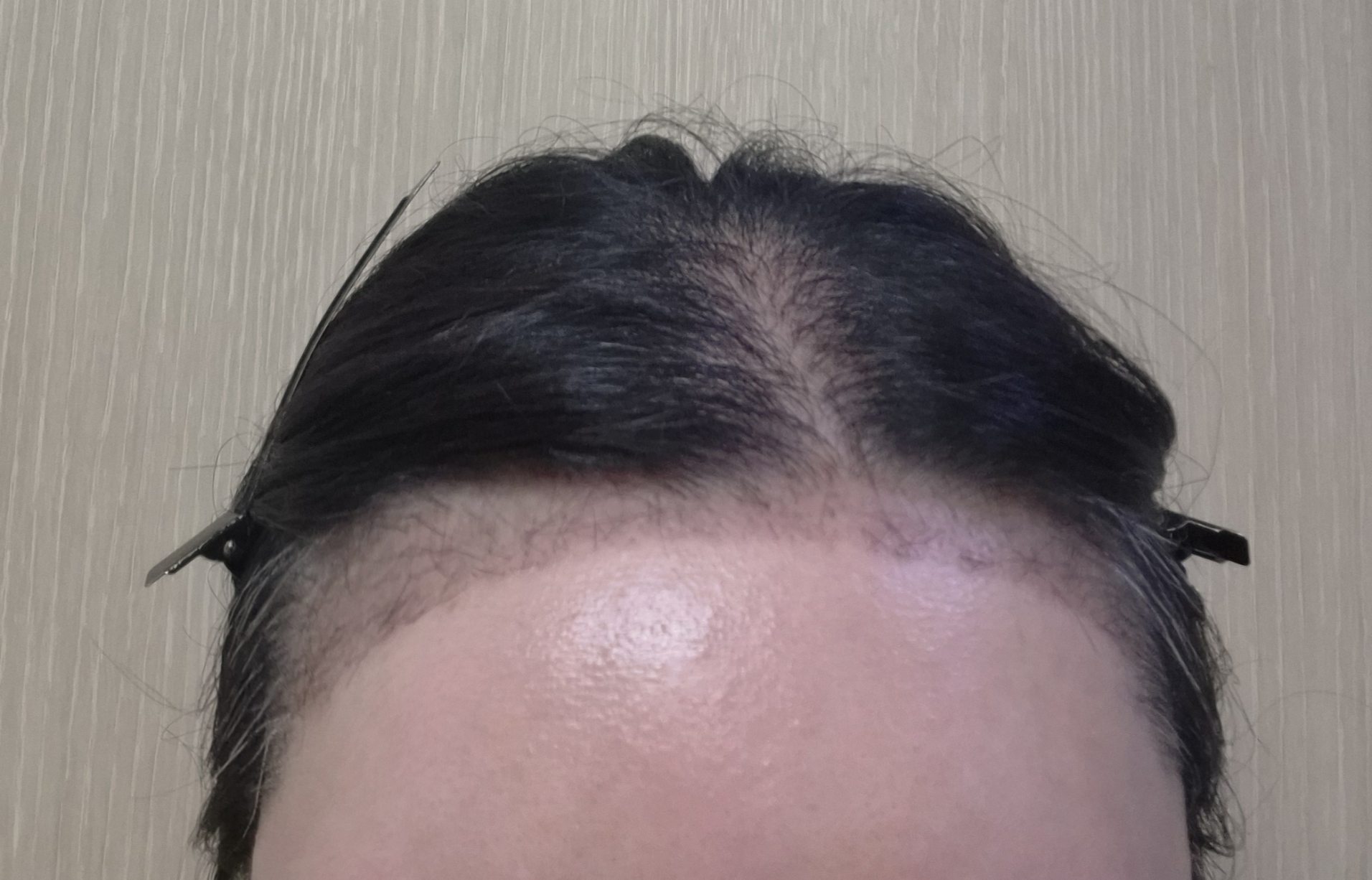 헤어라인까지 함께, 만족스러운 모발이식 후기