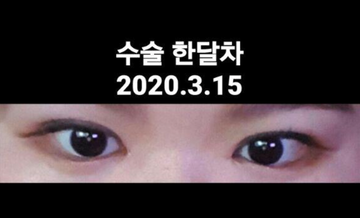 쌍꺼풀 눈매교정 앞트임 후기기기 ㅋ