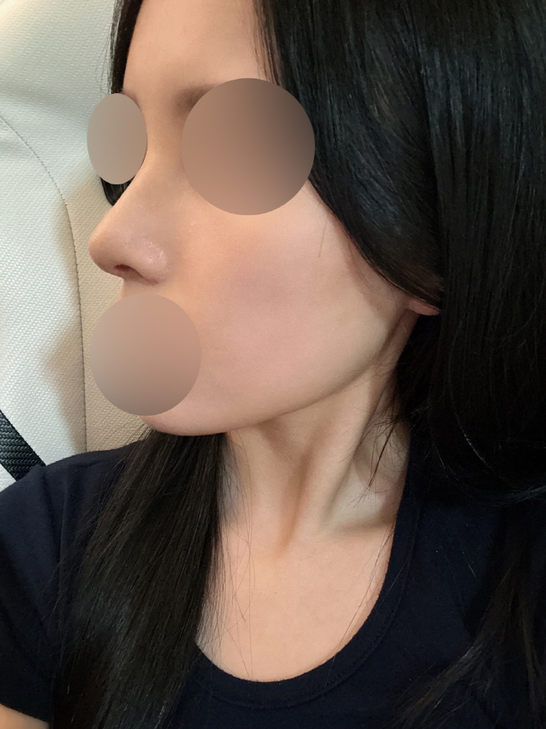 휜코도 똑바로 교정 되었고, 콧볼도 코에 맞게 이쁘게 수술 해주셨어요!!!!너무만족스러운 수술이예요!!