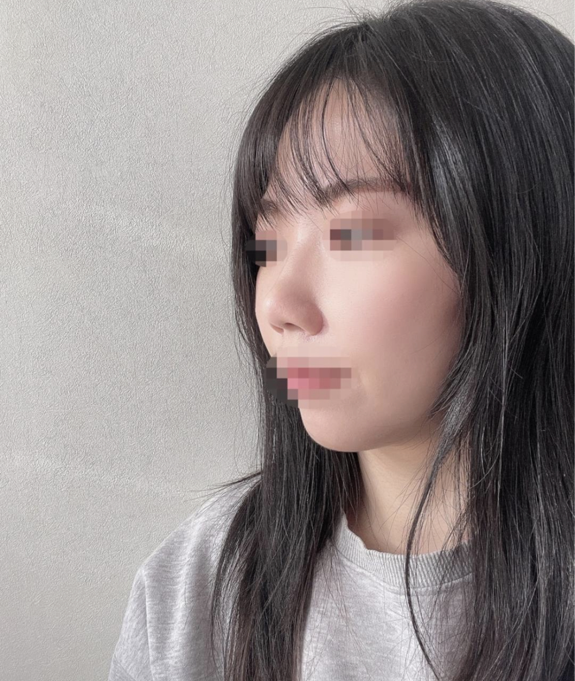 원장님 너무 친절하시고 수술도 잘 되어서 너무 만족스럽습니다!
