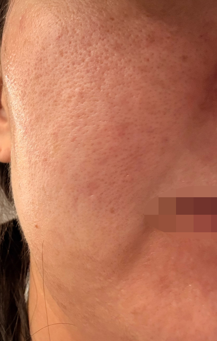 수면으로 진행해서 고통 하나 없이 편하게 받고 왔는데 진짜 만족스러워요ㅎ