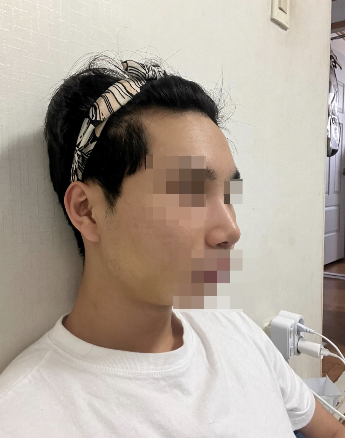 수술 후 일주일 차입니다.