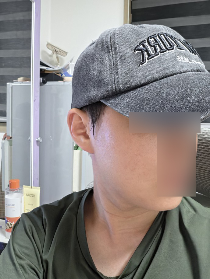 이중턱+턱라인 지흡 2주차, 벌써 라인이 달라 보여요