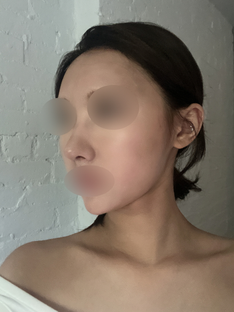 휜코 교정 했어요!
