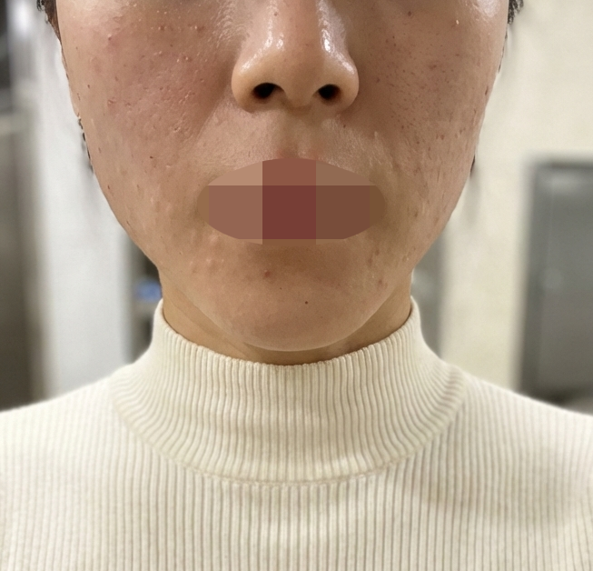 소문으로만 듣던 리쥬란 받으려고 방문했습니다ㅎㅎ