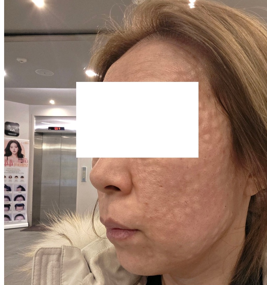 첫 방문인데 수면 마취 괜히 걱정했어요ㅎㅎ 촘촘하게 잘 해주셔서 만족~
