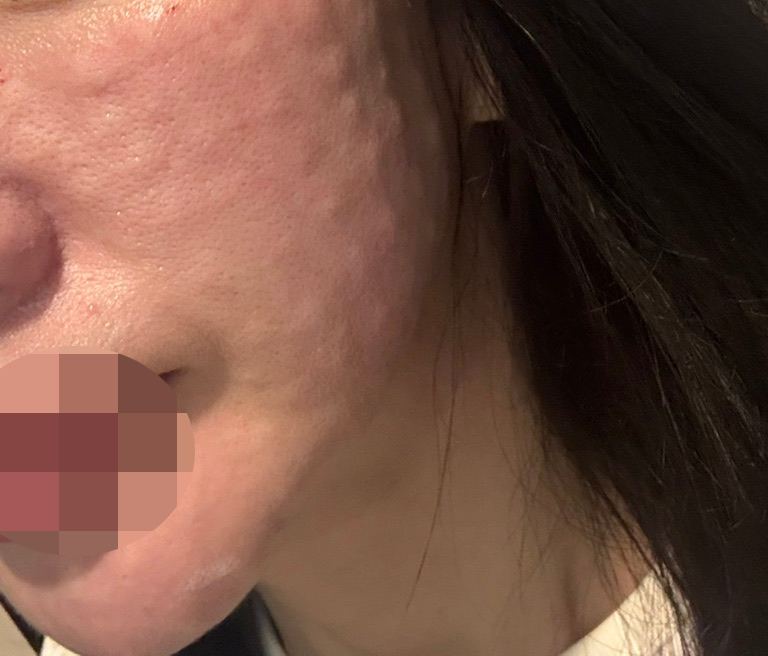 엠보 빵빵하게 잘 잡혀서 리쥬란 재방문했어요!!