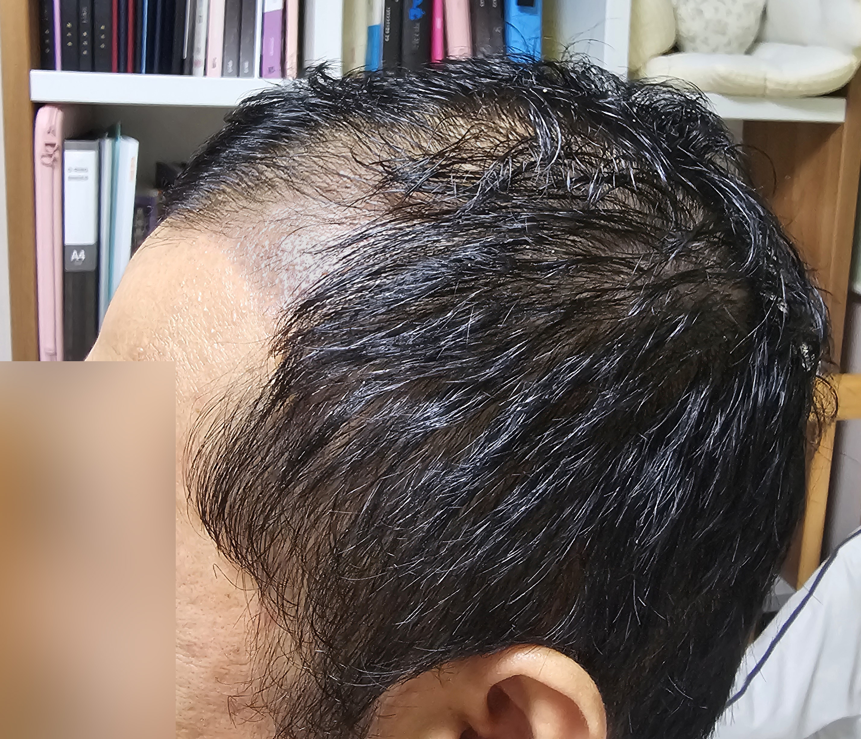 M자 절개 모발이식 3500모 한달 경과