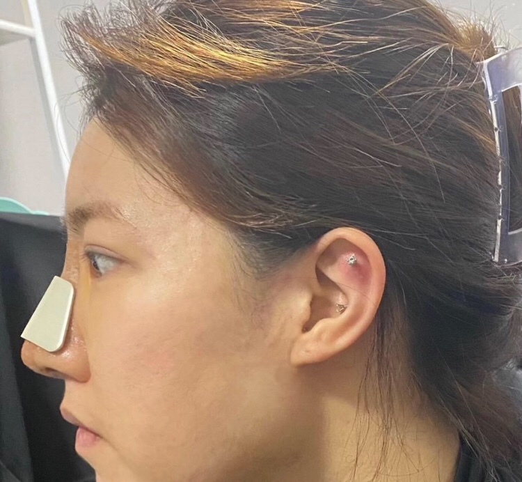 코 수술