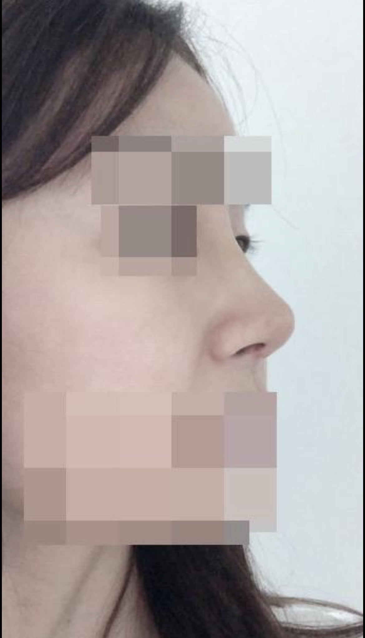 드디어 했네요 코 수술ㅋ