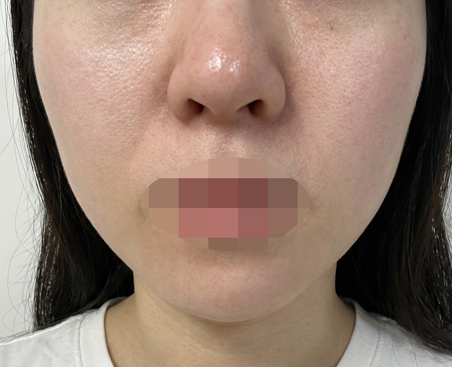 홍조이랑 모공 고민으로 엑소좀 받아봤습니당~