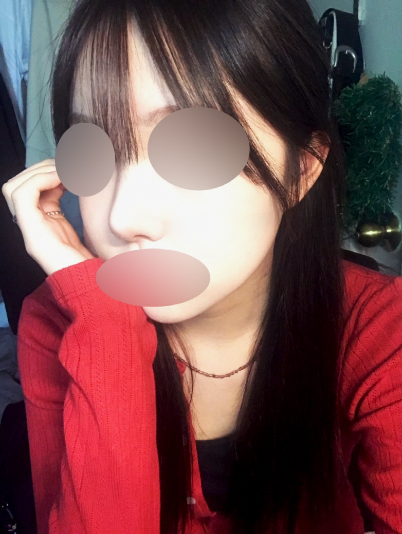 잔붓기 빠지고 코끝이랑 콧대 라인이 훨씬 자연스러워졌어여
