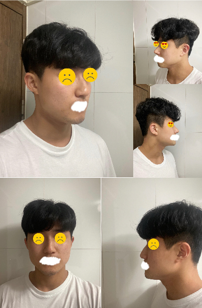 한달차 매부리코 수술후기