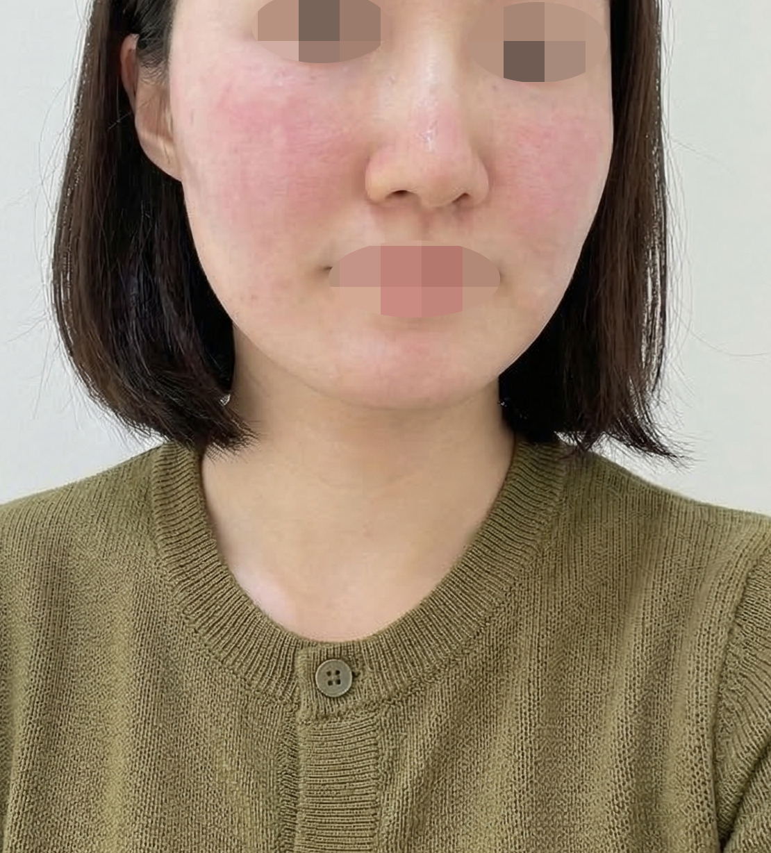 피부 관리 다시 시작하려고 리쥬란 받았어요~ 강남역에서 가까워서 너무 좋아요!
