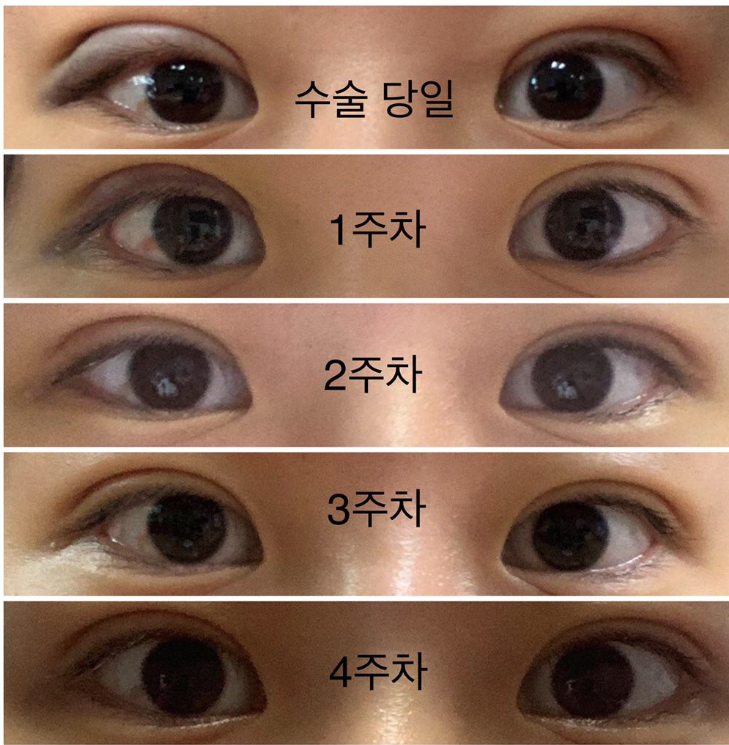 자연유착 후기