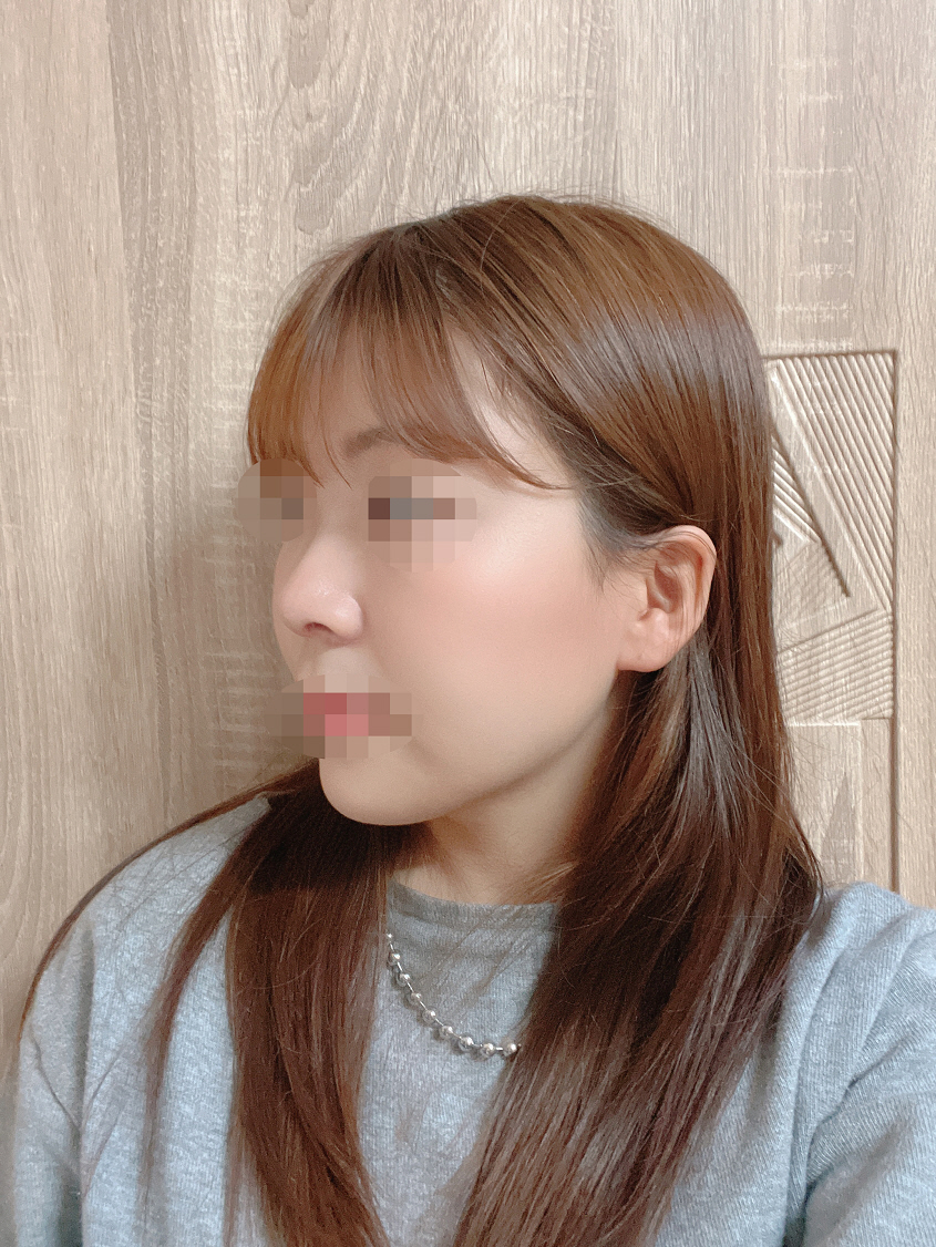 자연스러운 코 원하시면 황원장님 강력 추천드려요 !