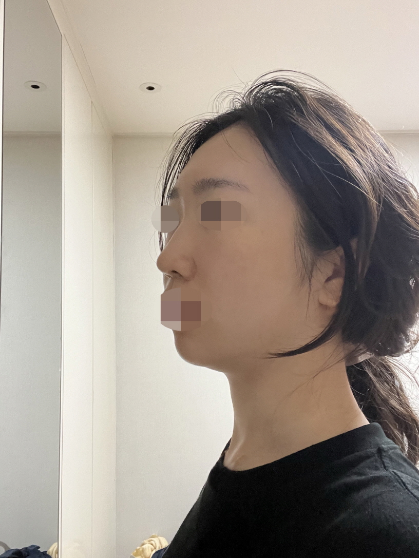 합리적이게 자연스러운 코 재수술 했습니다