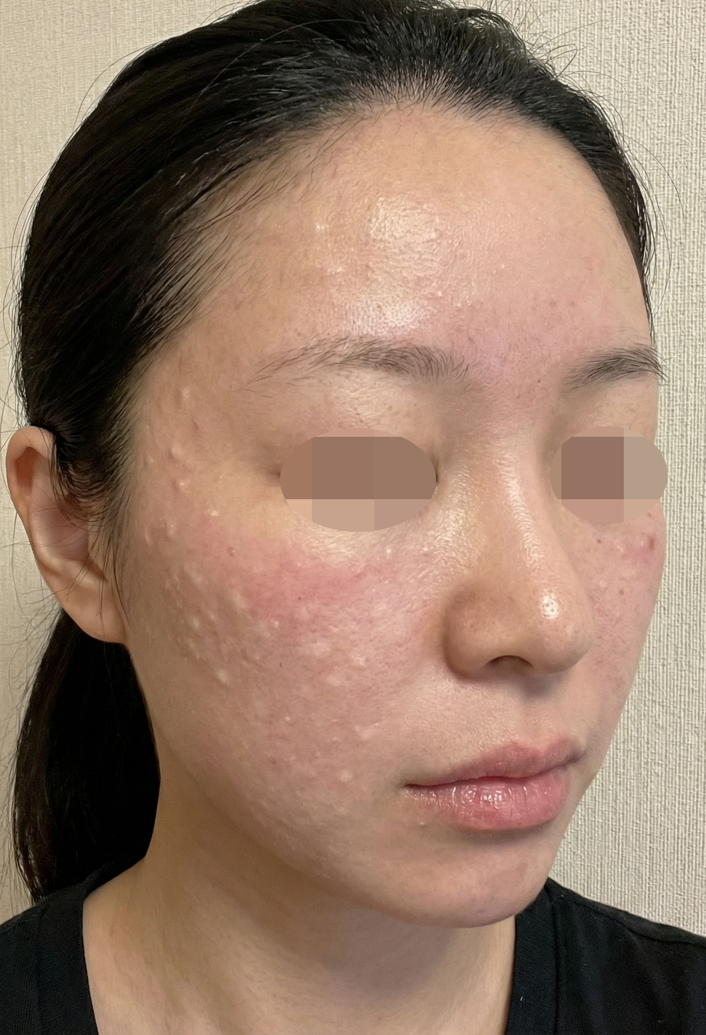 업셀링 없이 친절하게 상담해주셔서 좋았어요~ 3주 후 탄력 굿!!