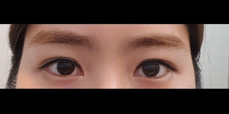 눈 재수술 2달 넘어써용ㅋㅋㅋ