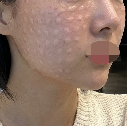 잔주름 고민으로 쥬베룩, 엠보 촘촘하게 잘 나와서 만족이에요!!